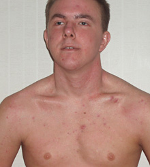 Kristoffer Nilssonin iho neljän viikon hoitokuurin jälkeen